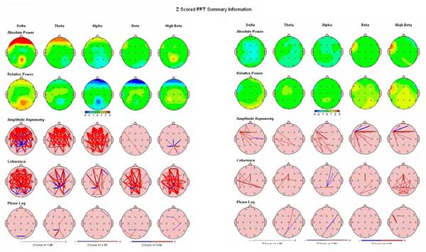 QEEG Messung Grafik